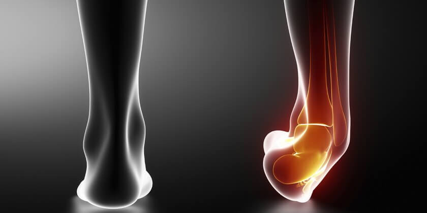 El esguince se produce cuando el tobillo se dobla hacia afuera.