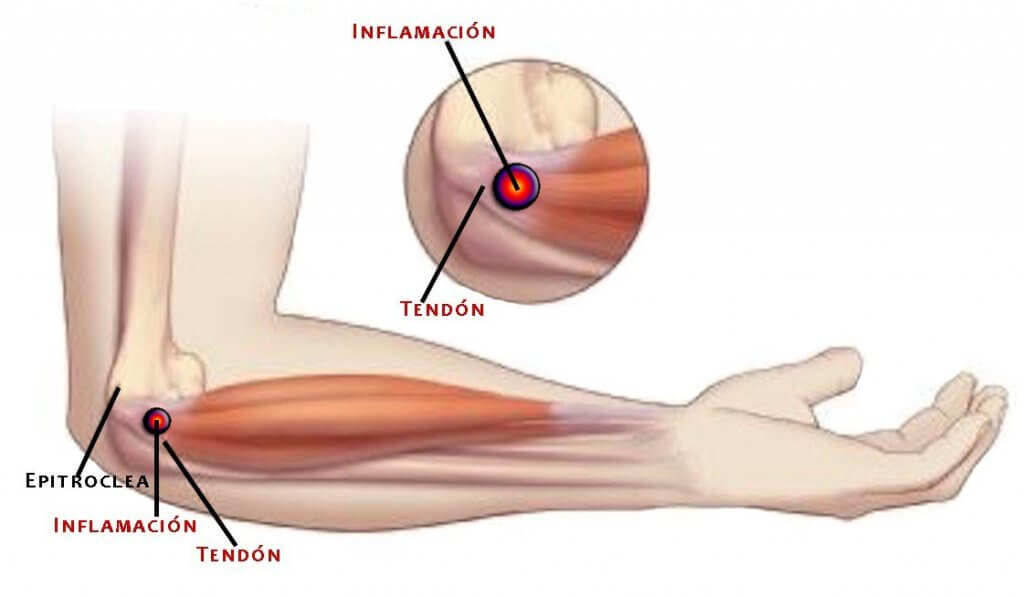 Dolor antebrazo derecho parte externa