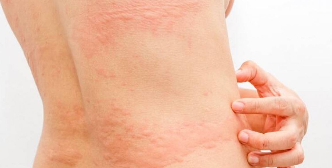La urticaria es una reacción alérgica.