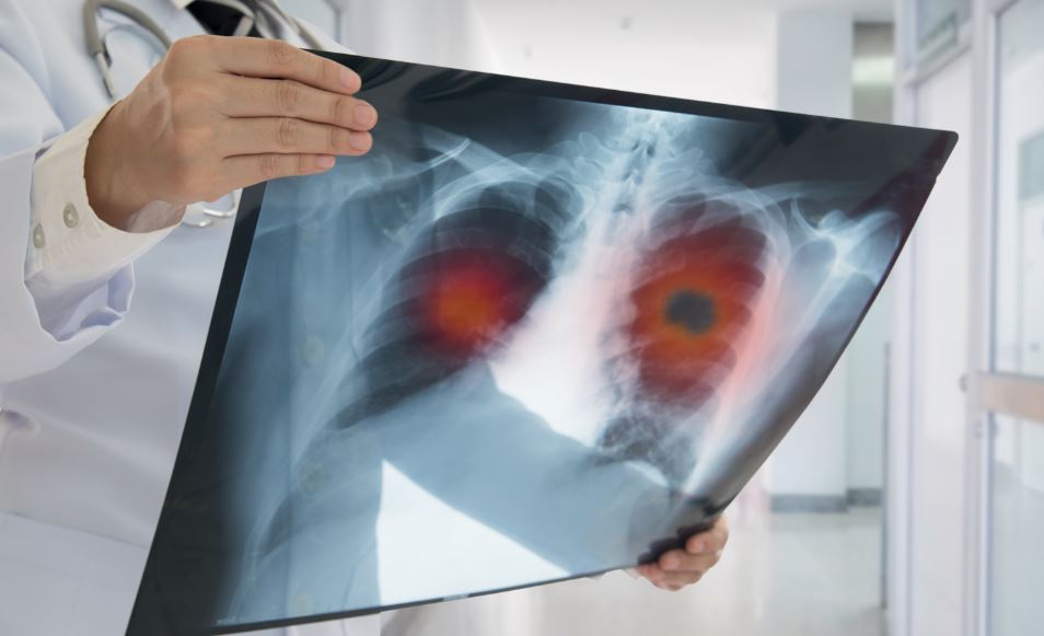 Cáncer de pulmón.
