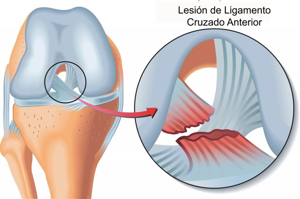La más común de las lesiones en el esquí alpino es la rotura del ligamento cruzado anterior. 