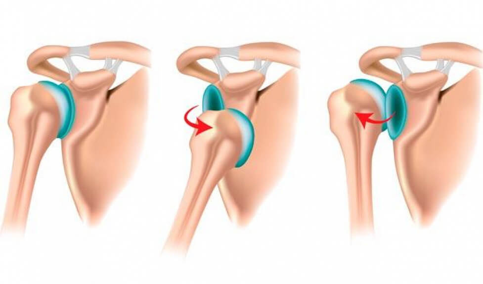La luxación de hombro también es una lesión habitual en el esquí alpino.