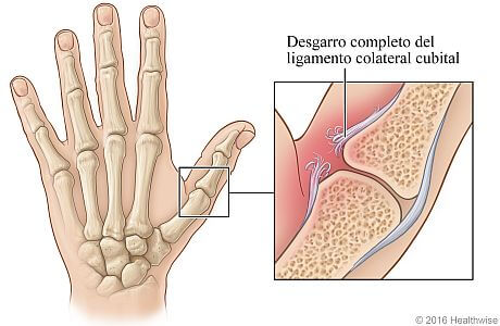 Cuando se da la lesión llamada pulgar del esquiador, el ligamento que se encuentra en la base del dedo pulgar se rompe como consecuencia de una hiperextensión. 