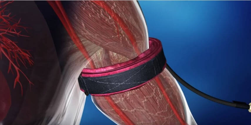 Entrenamiento oclusivo aplicado sobre un brazo.