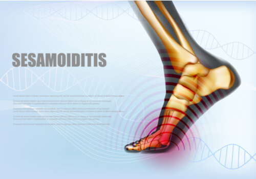 Esquema de la sesamoiditis.