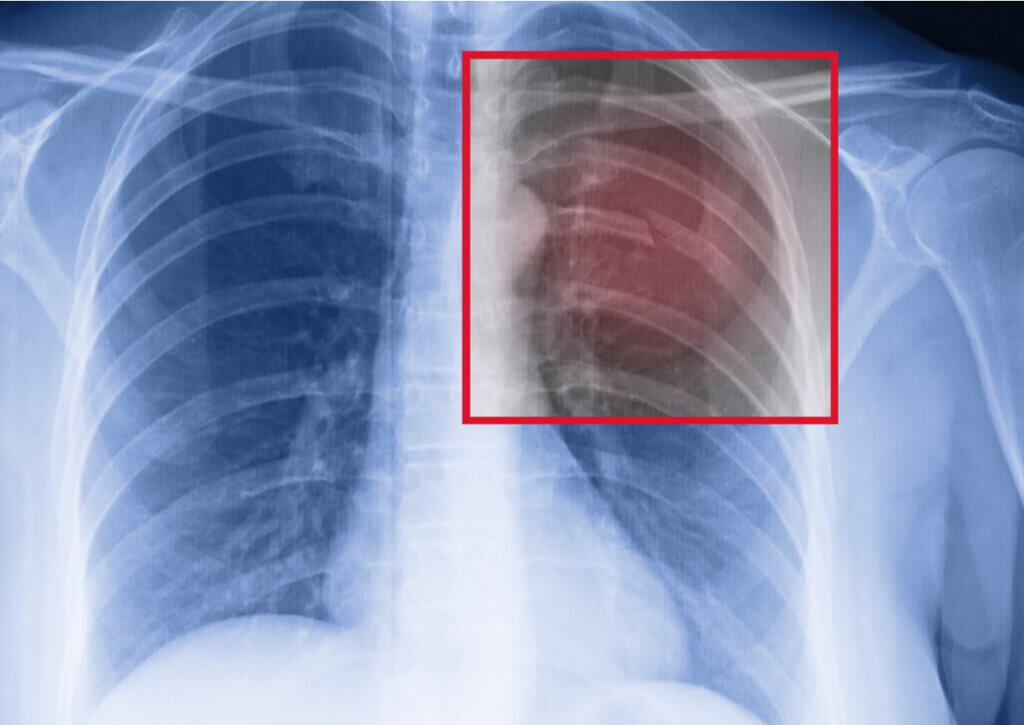 Radiografía de una fractura costal causada por estrés.