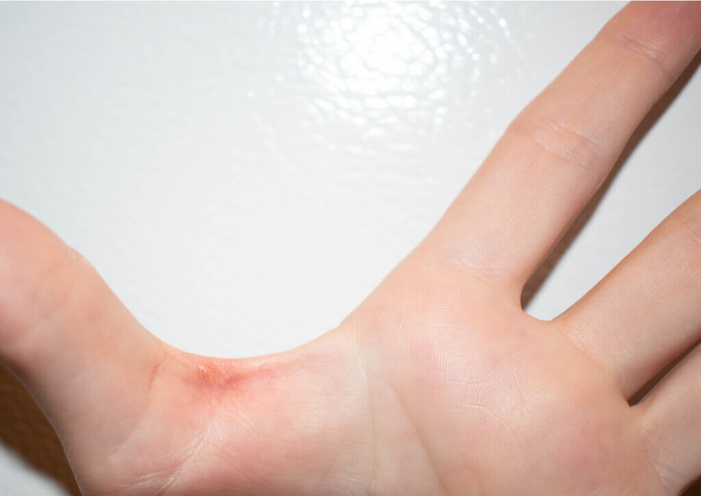 Las quemaduras por fricción son comunes al usar elementos como las barras de dominadas.