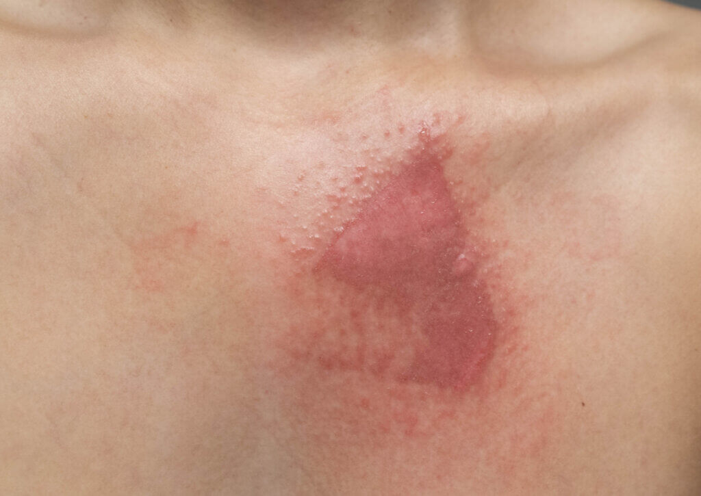 Hombre padece una quemadura por fricción tras un accidente de automóvil.